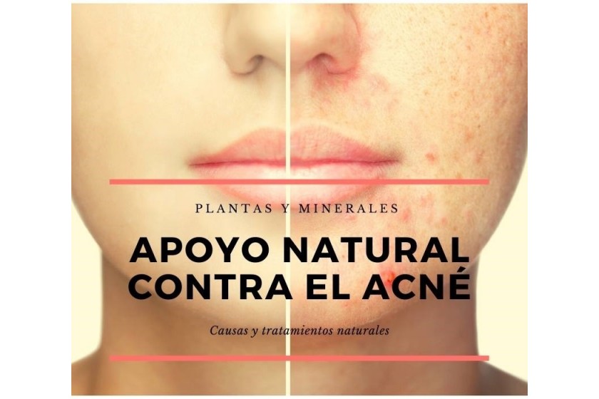 Apoyo natural contra el acné