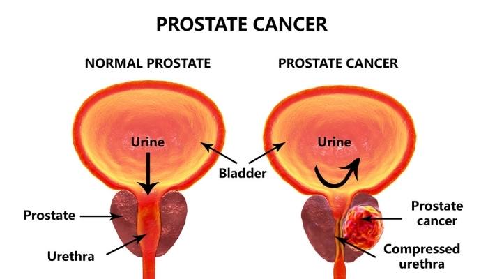 Cancer de prostata